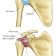 Adult Managing Frozen Shoulder with Stage-appropriate Exercise at Private Norwest Hills District Studio