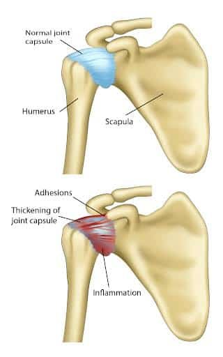 Adult Managing Frozen Shoulder with Stage-appropriate Exercise at Private Norwest Hills District Studio