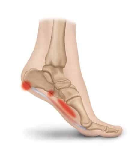 Adult Managing Plantar Fasciitis Heel Pain with Foot and Calf Strengthening at Private Norwest Hills District Studio